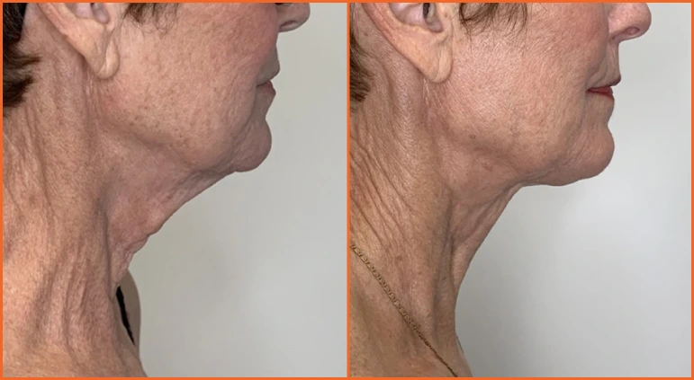 Chin Liposuction Before And After Results Banner