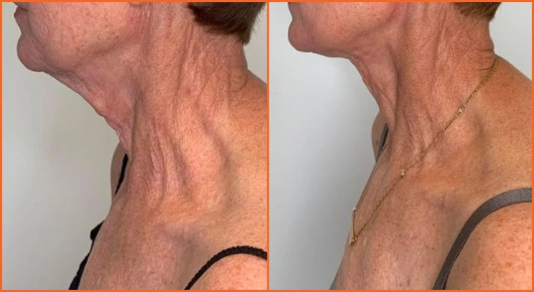 Chin Liposuction Before And After Results Banner