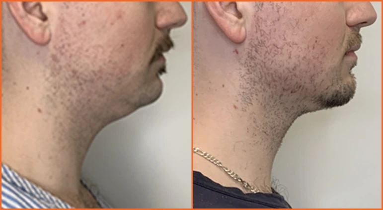 Chin Liposuction Before And After Results Banner