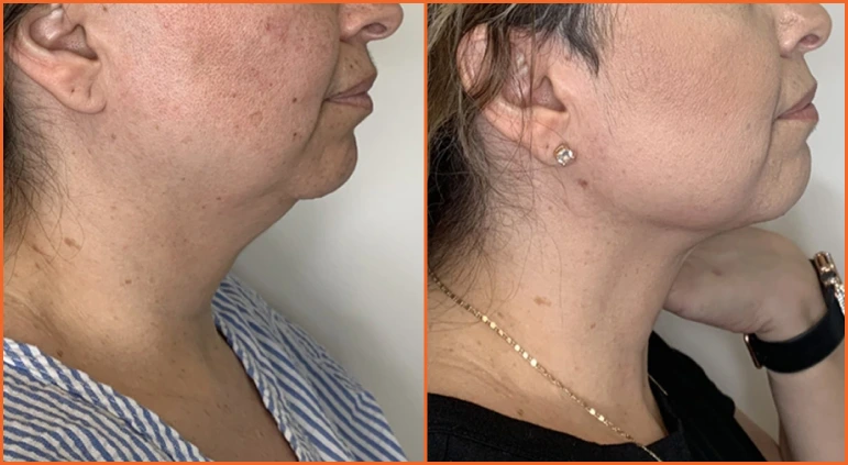Chin Liposuction Before And After Results Banner
