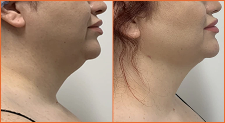Chin Liposuction Before And After Results Banner
