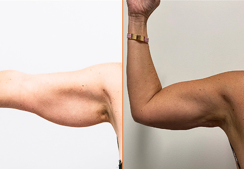 Arm Liposuction h3