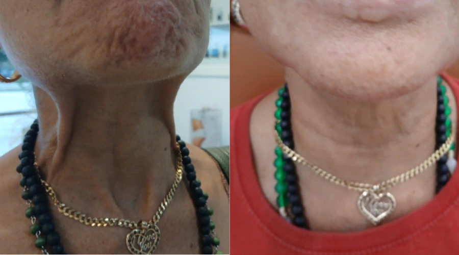 Botox - Case 1