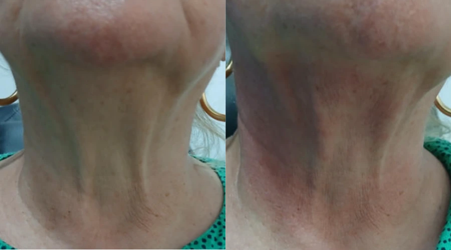 Cryochin - Case 3 (1)
