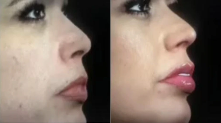 Lip Filler - Case 2 (1)
