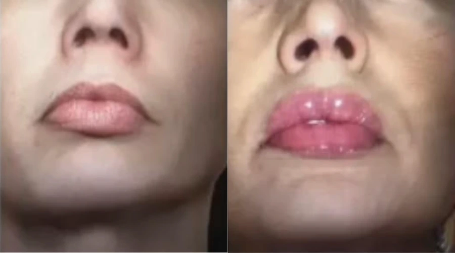 Lip Filler - Case 2 (2)