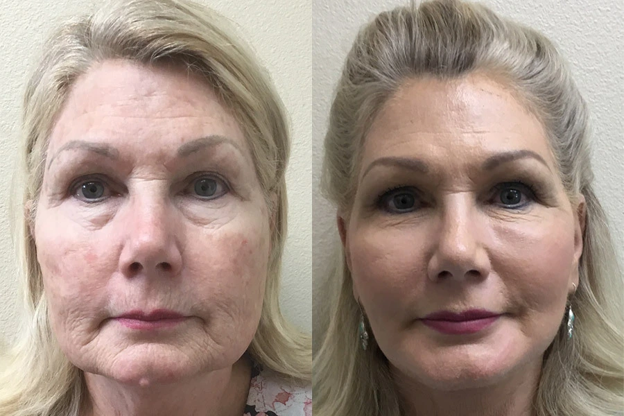 CJ-FACE.NECK-RENUVION-RESURFACING-BEFORE