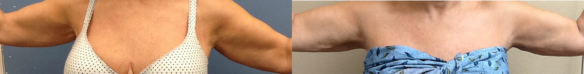 ES-RENUVION-ARMS-AFTER