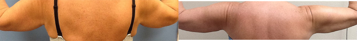 ES-RENUVION-ARMS-POSTERIOR-AFTER