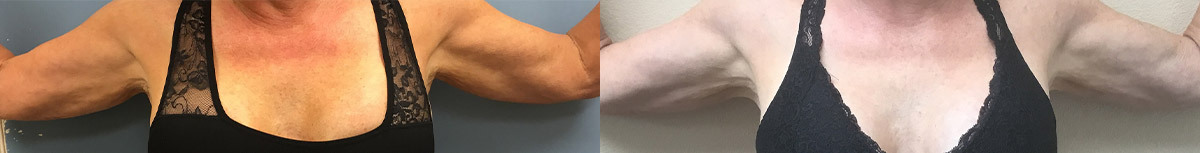 MT-RENIVON-ARMS-BEFORE