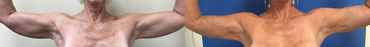 TE-JPLASTY-ARMS-AFTER-1