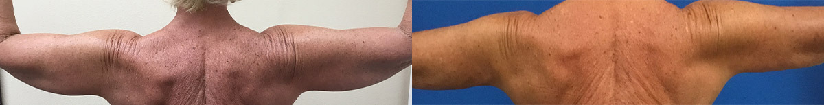 TE-RENUVION-ARMS-POSTERIOR-BEFORE