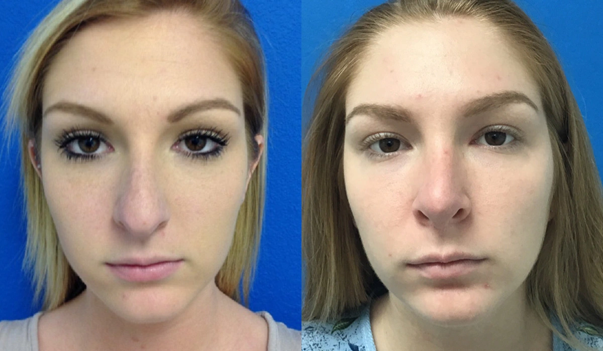 Rhinoplasty Before & After Banner