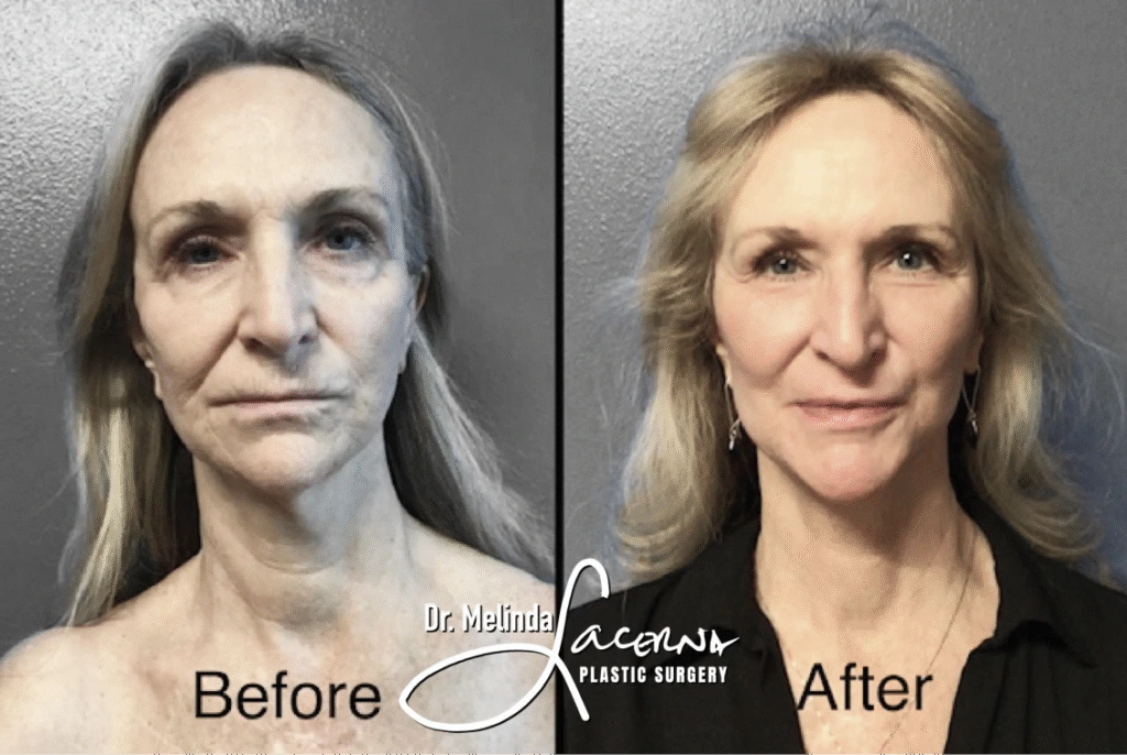 Before & After Gallery Facelift Banner