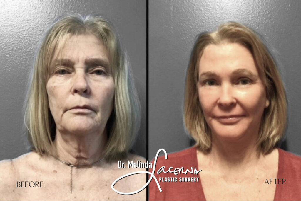 Before & After Gallery Facelift Banner