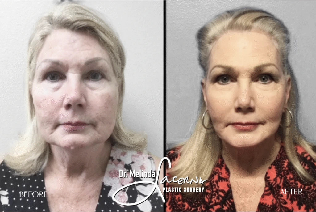 Before & After Gallery Facelift Banner