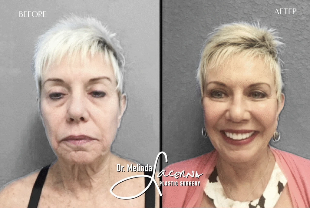 Before & After Gallery Facelift Banner