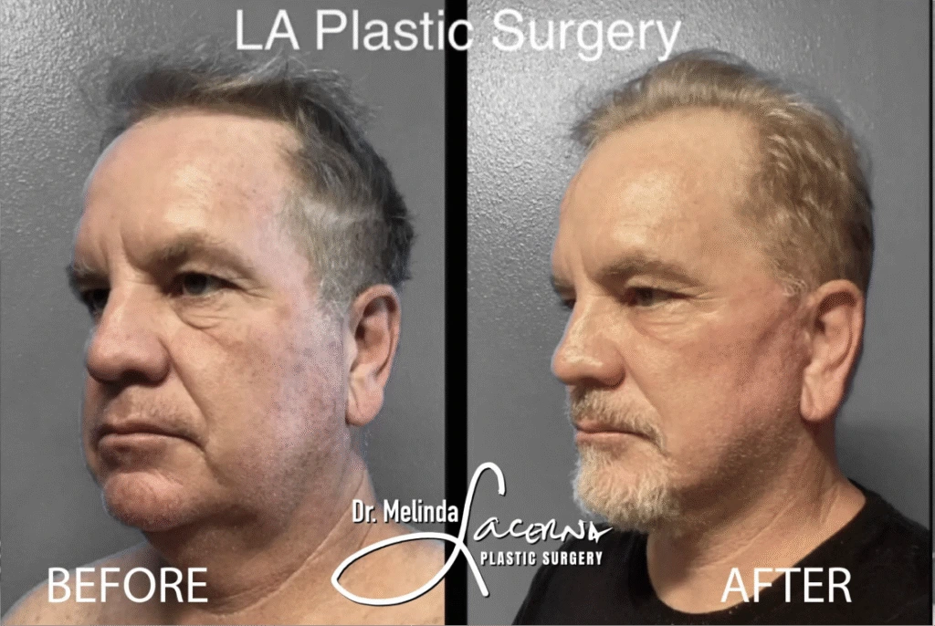 Before & After Gallery Facelift Banner