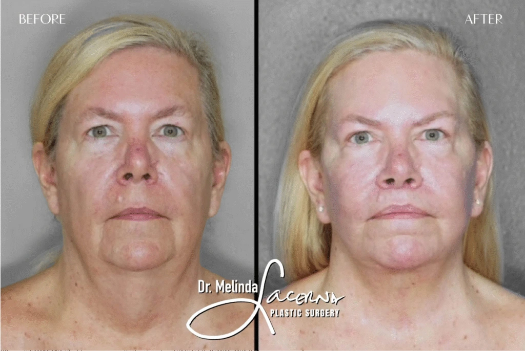 Before & After Gallery Facelift Banner