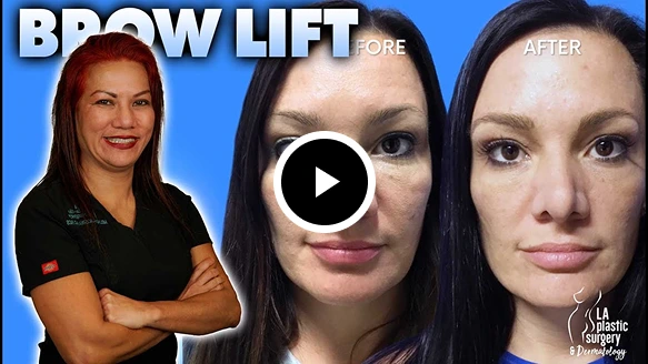 Female Brow Lift Patient Video Thumbnail