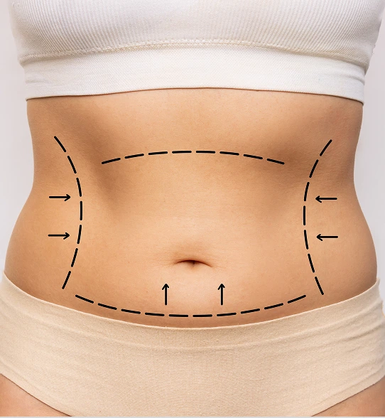Bradenton Florida Body Treatments: Liposuction Banner