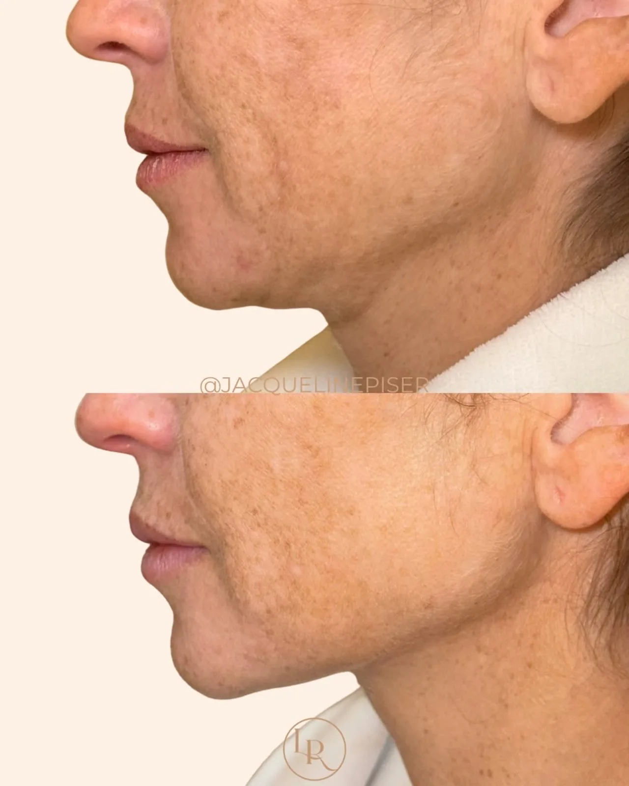 Before and after profile views showing skin texture improvement on jawline and neck after Sofwave treatment