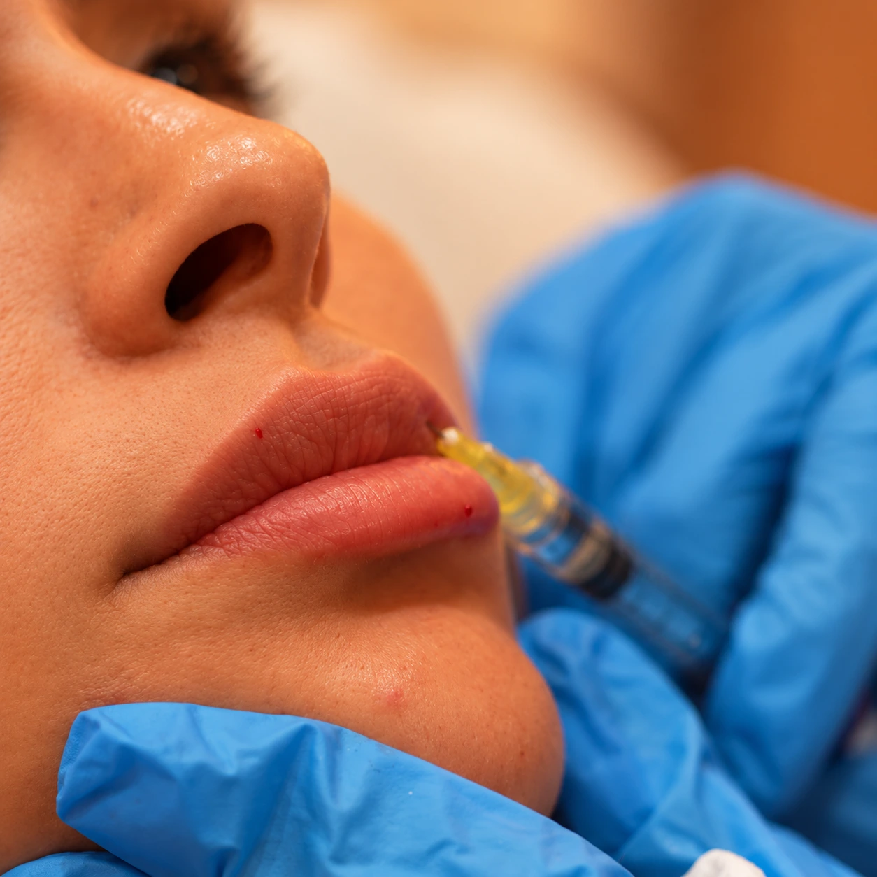 Close-up of a lip filler injection at La Réserve Aesthetics