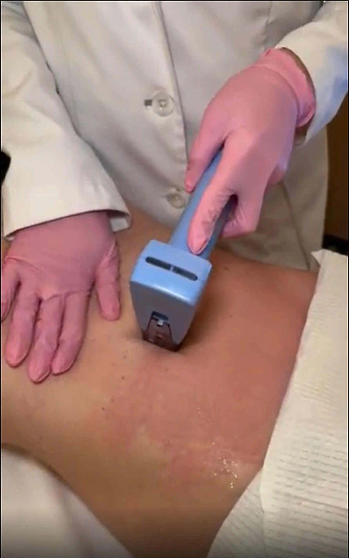Provider in pink gloves applying Morpheus8 Body device to patient's skin on arm