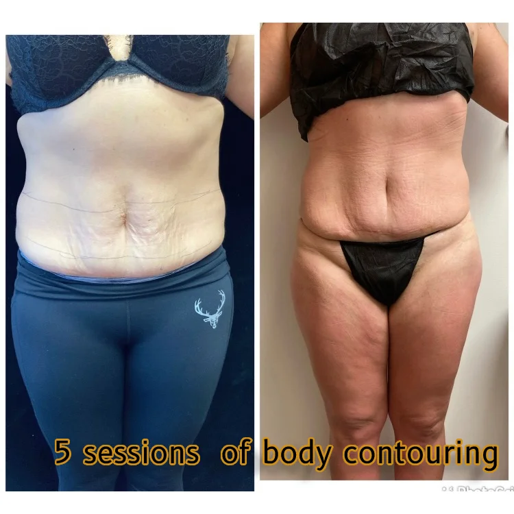 bodycontouring-new-01