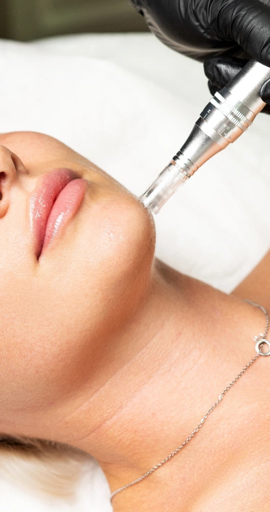 Microneedling Procedure