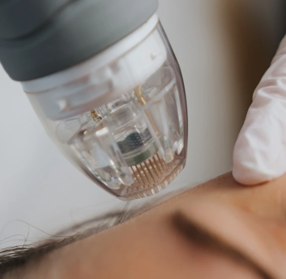 Microneedling With PRP