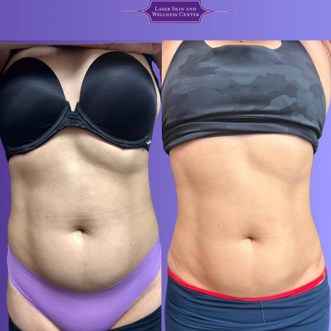 Liquid Lipo - Case 5