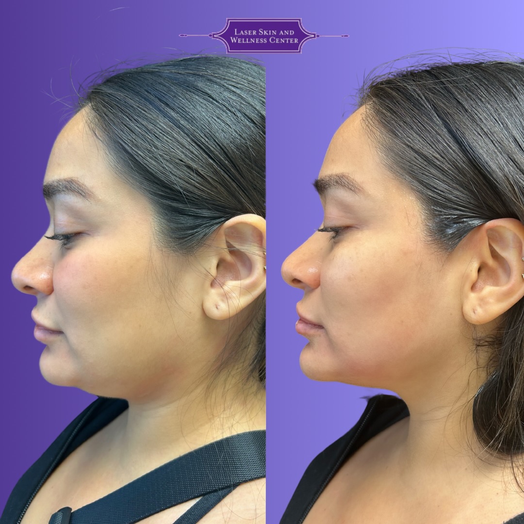 Olgio Skin Tightening Case 4-1