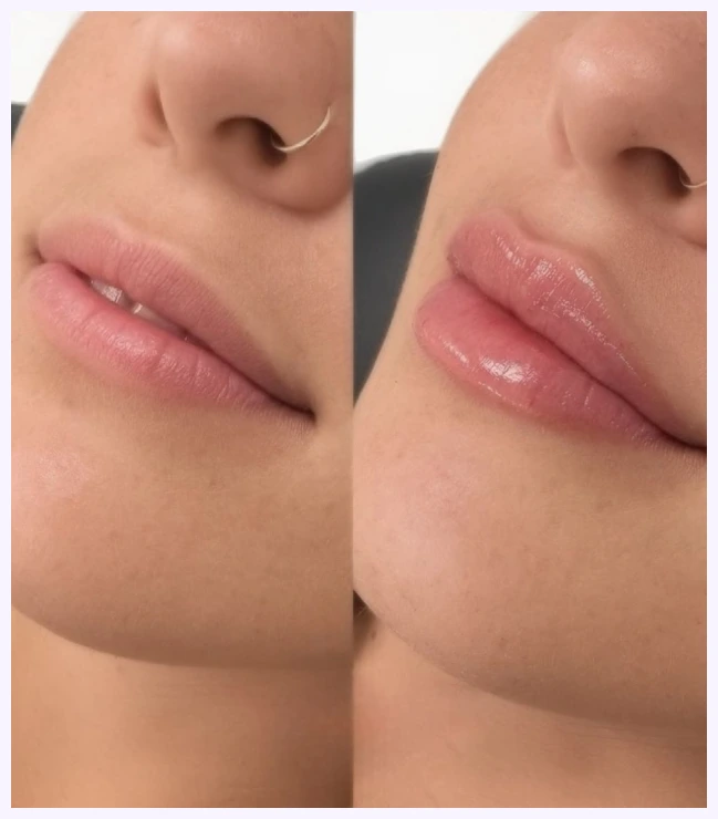 About Lip Fillers Banner