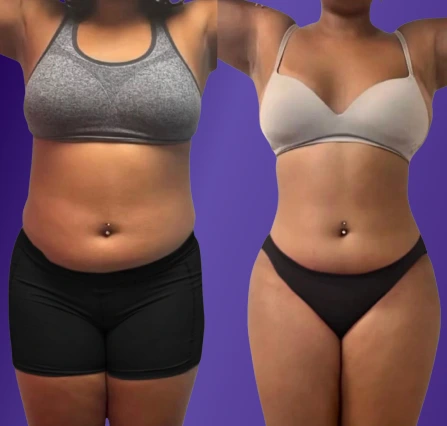 Body Contouring Before & After Banner