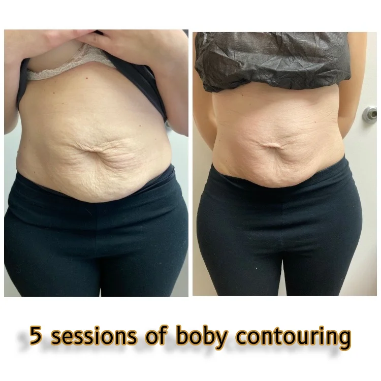 bodycontouring-new-04