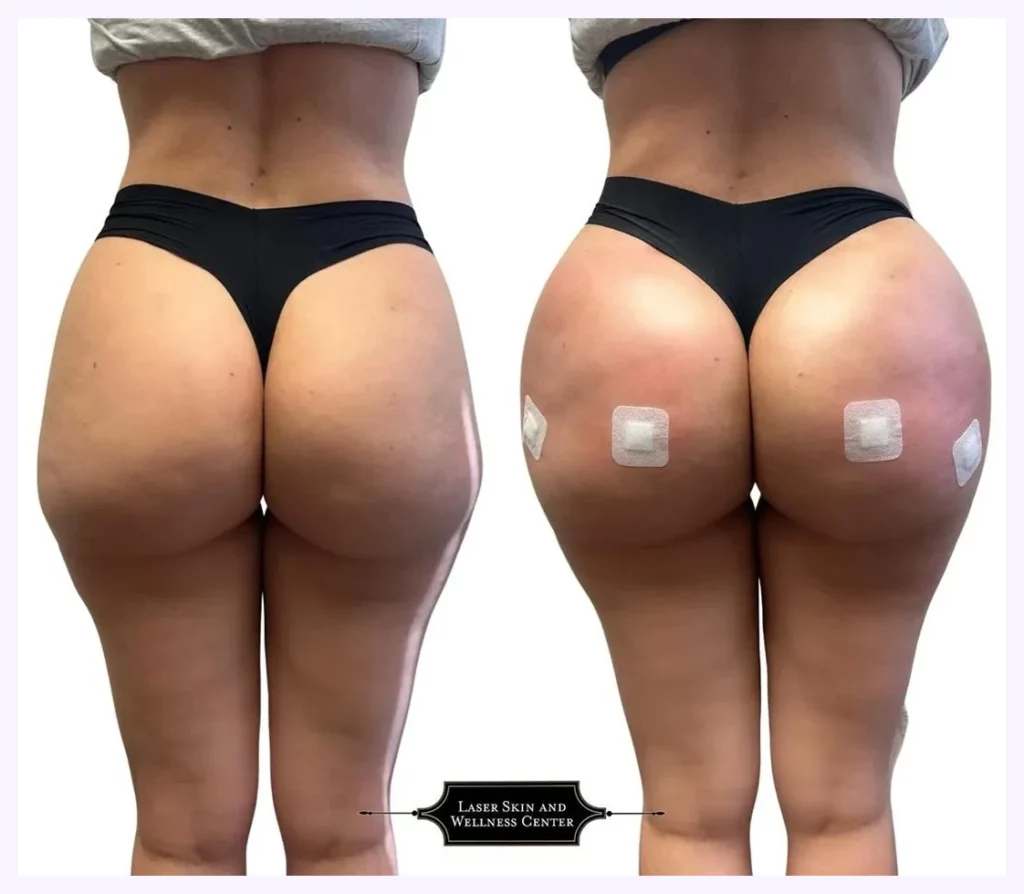 Liquid BBL Before and After Gallery