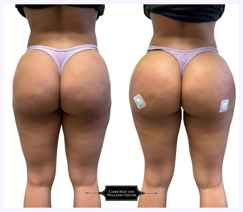 Liquid BBL Before and After Gallery