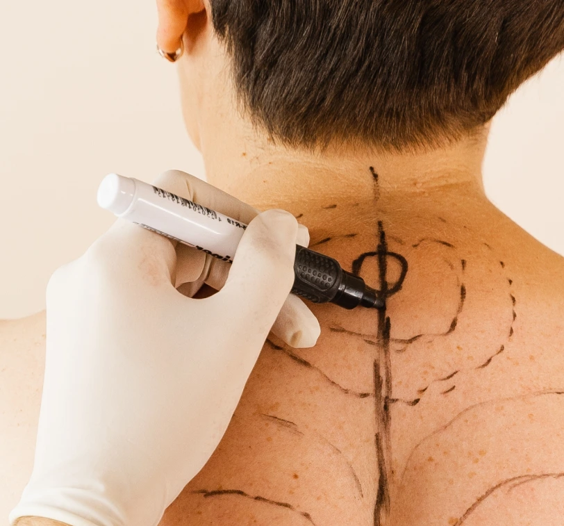 Buffalo Hump Liposuction Procedure Banner