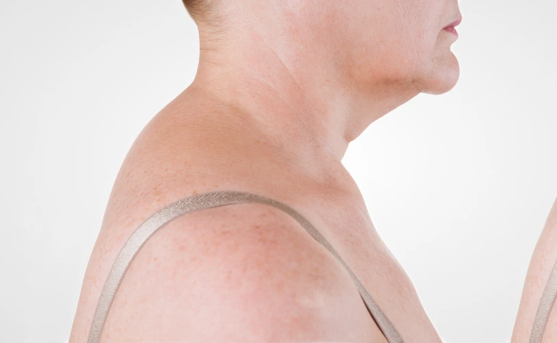 What Is Buffalo Hump Liposuction? Banner