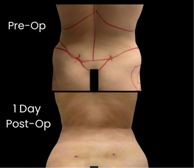 Before and after liposuction comparison showing pre-op markings and 1 day post-op results on abdomen and flanks
