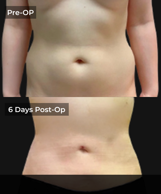 Before and after liposuction comparison showing abdominal contour improvement from pre-op to 6 days post-op