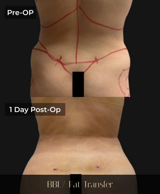 Pre-operative and 1 day post-operative comparison of abdomen with surgical markings and incisions from BBL/Fat Transfer procedure