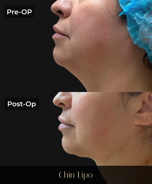 Side-by-side before and after profile views showing chin definition improvement from chin lipo procedure