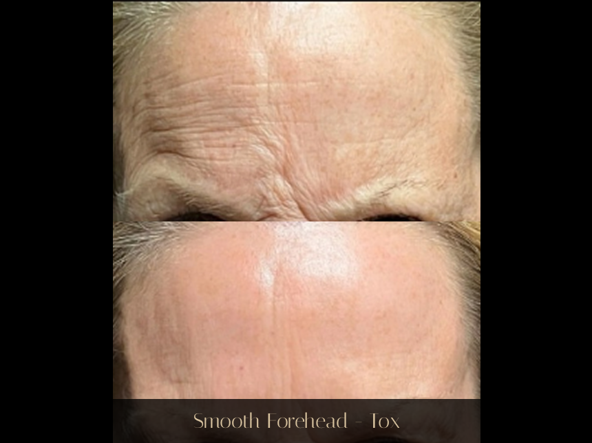 Before and after forehead showing reduced wrinkles from Botox treatment