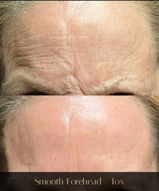 Before and after forehead comparison showing reduced wrinkles from Botox treatment