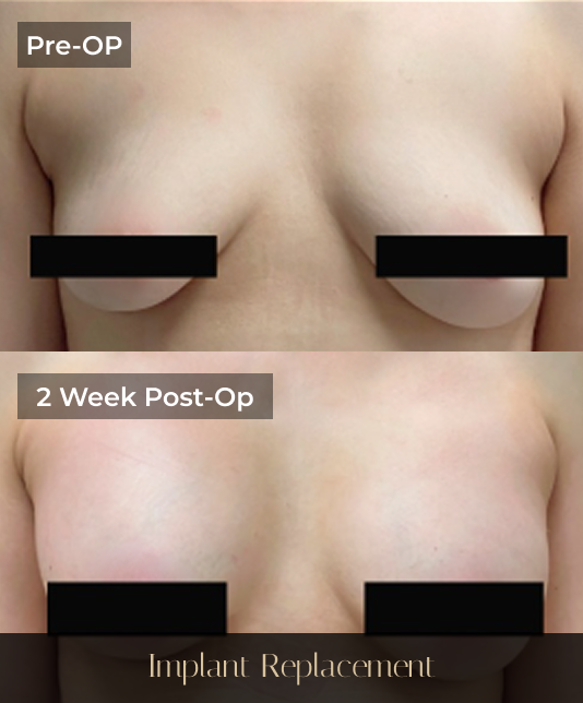 Pre-operative and 2 week post-operative comparison of breast implant replacement results