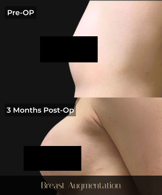 Before and after breast augmentation comparison showing pre-operative and 3 months post-operative results