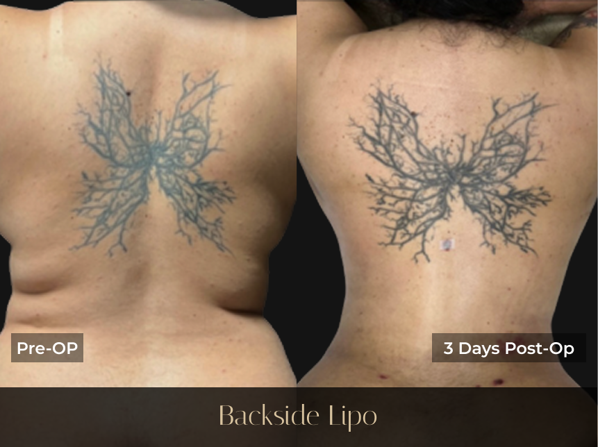 Before and after backside lipo: pre-op and 3 days post-op comparison showing reduced contours on patient's back