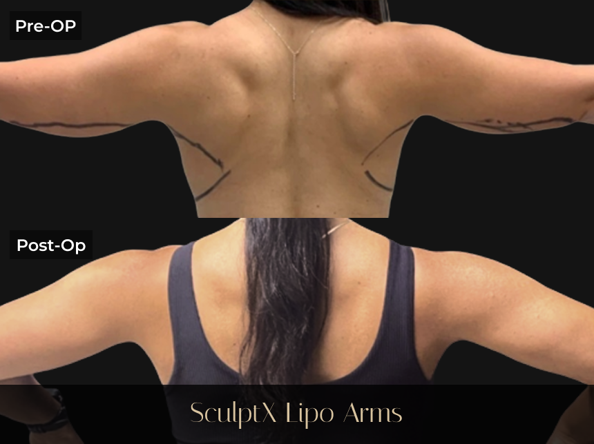 Pre-op and post-op comparison of patient's arms showing reduced fullness and improved definition after SculptX Lipo Arms procedure